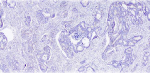 Imatge de microscopi d'un tumor colorectal
