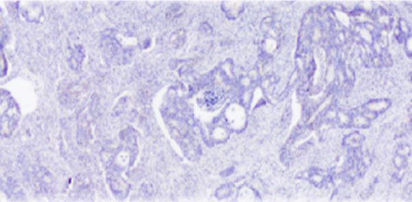 Un estudi liderat pel santboià Manel Esteller descobreix que existeixen diferències entre les cèl·lules d’un tumor de còlon
