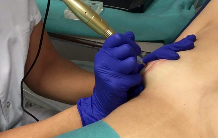 La micropigmentación de la areola-pezón posterior a un proceso oncológico se extiende por Catalunya
