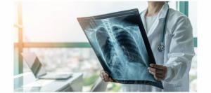 Bellvitge impulsa un avance clave en la lucha contra la fibrosis pulmonar post-COVID
