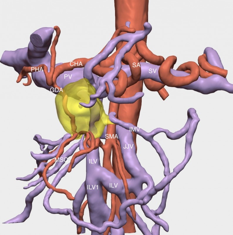 Reconstrucción del tumor en tres dimensiones (Autor: Cella Medical Solutions)